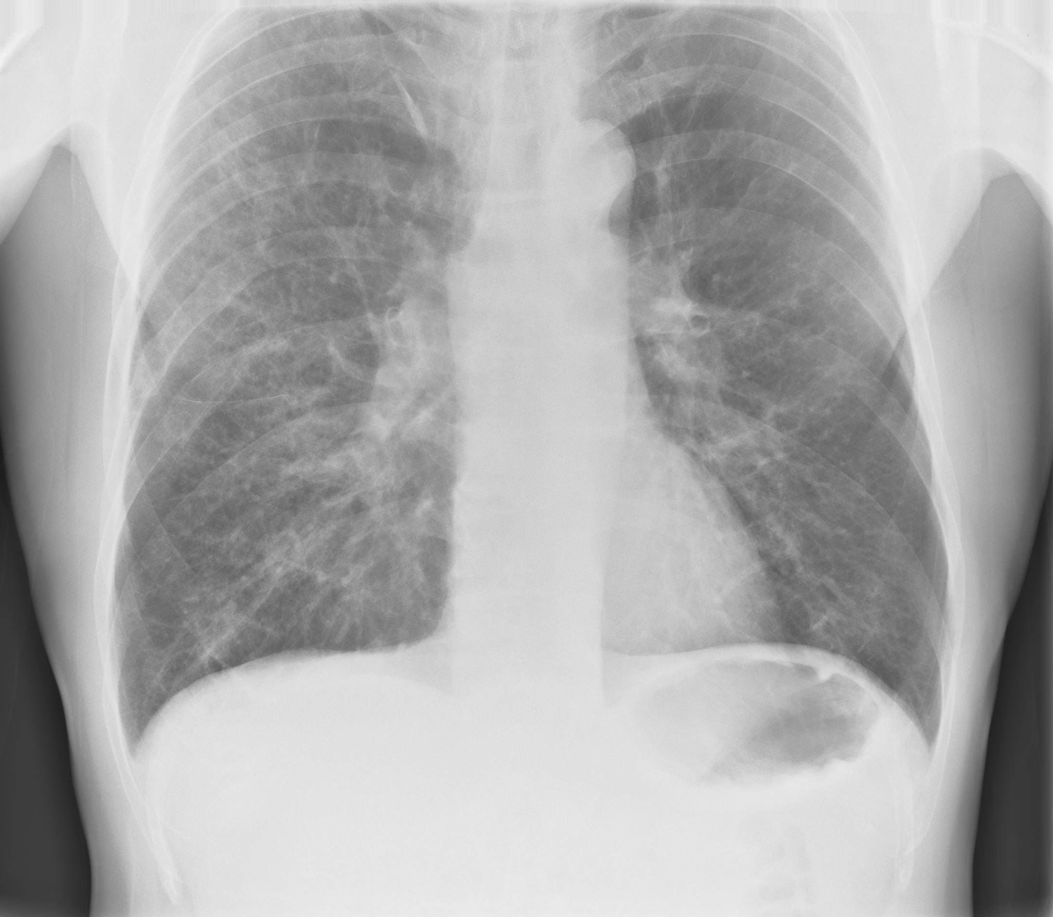 Chest radiograph, PA view — right lung shows diffuse patchy infiltrates consistent with pneumonia
