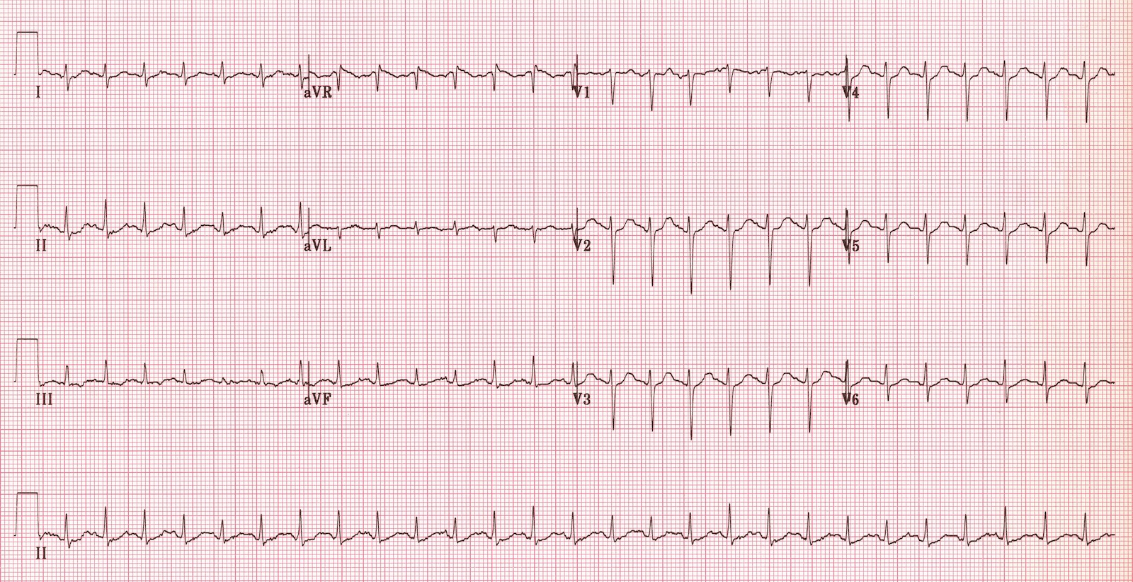 12-lead ECG showing a regular, rapid rhythm consistent with sinus tachycardia